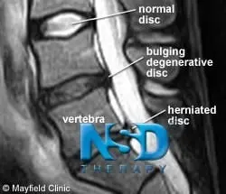 MRI of proven slip disc treatment without surgery in Kuala Lumpur Malaysia